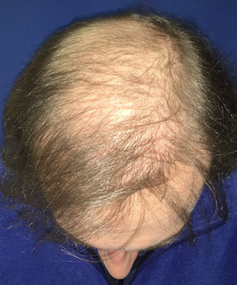 ALMI Before & After Gallery - Patient 131460 - Image 2