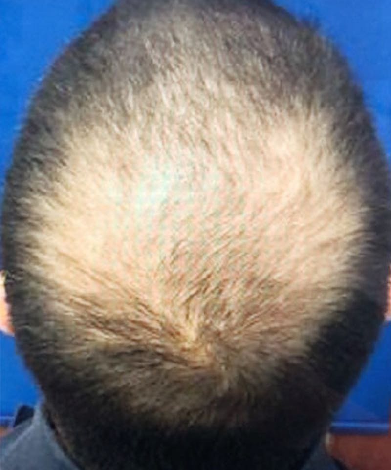 ALMI Before & After Gallery - Patient 979468 - Image 1