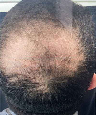 ALMI Before & After Gallery - Patient 979468 - Image 2