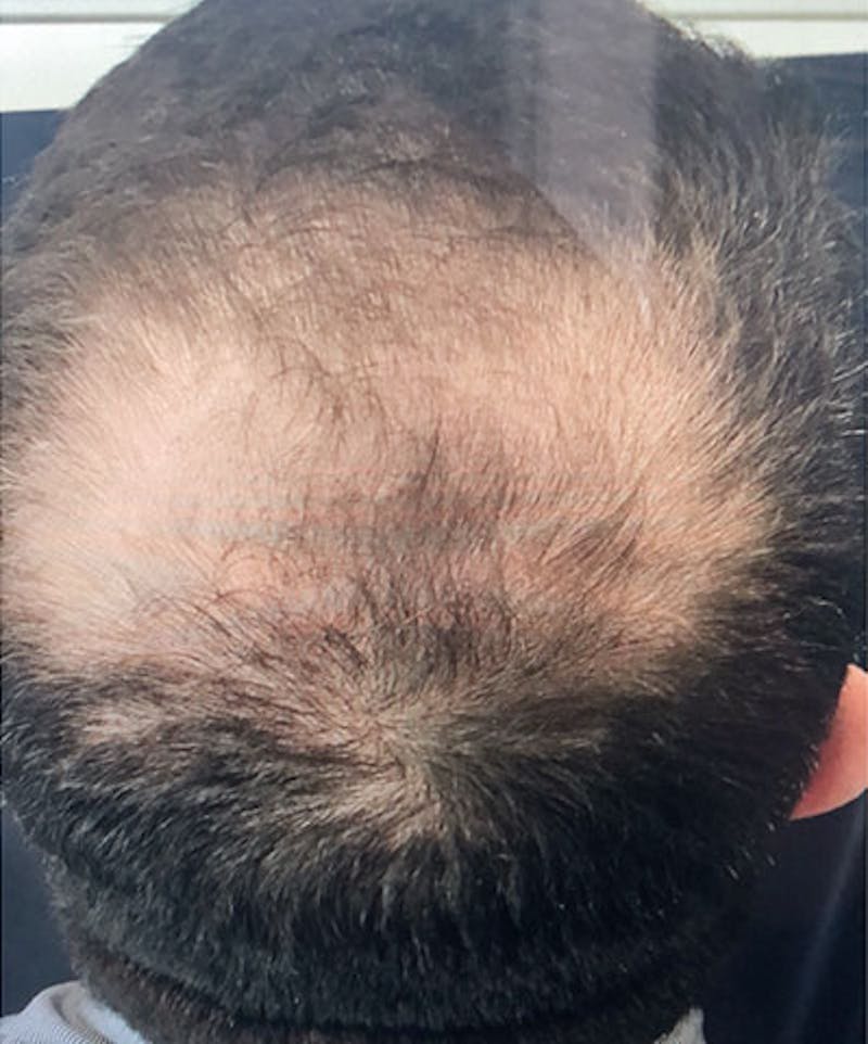 ALMI Before & After Gallery - Patient 979468 - Image 2