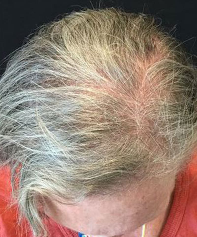 ALMI Before & After Gallery - Patient 463381 - Image 1