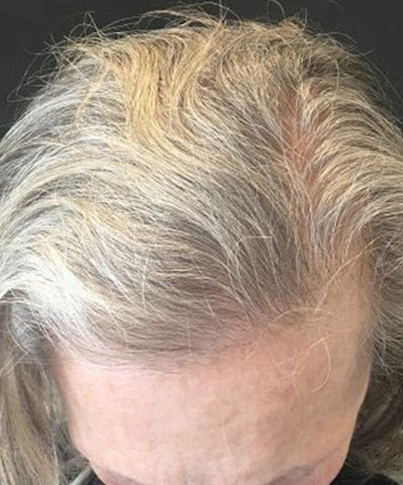 ALMI Before & After Gallery - Patient 463381 - Image 2