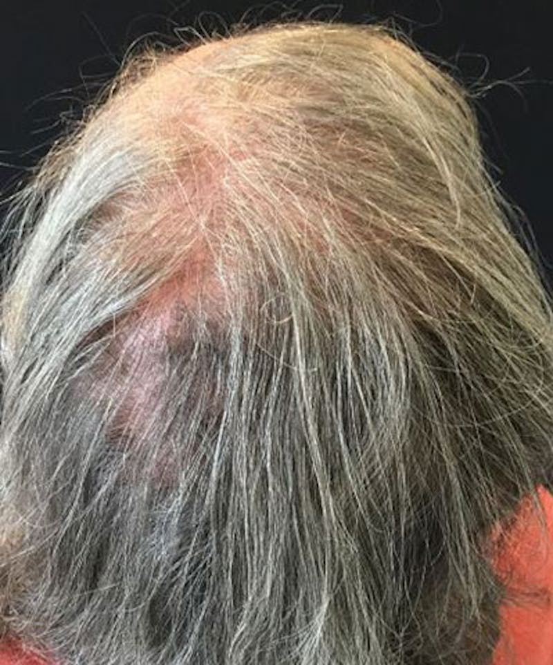 ALMI Before & After Gallery - Patient 463381 - Image 3
