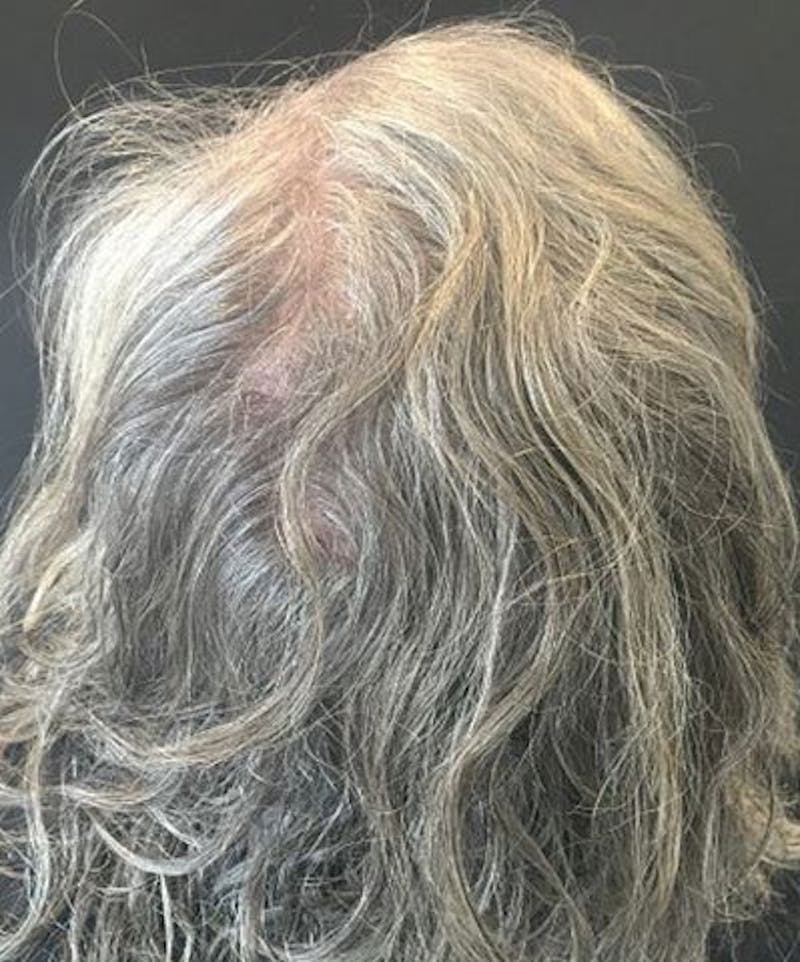 ALMI Before & After Gallery - Patient 463381 - Image 4