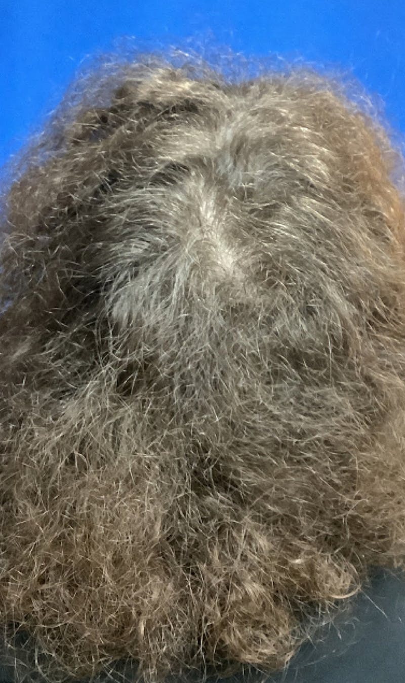 ALMI Before & After Gallery - Patient 302015 - Image 2