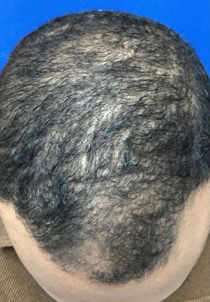 ALMI Before & After Gallery - Patient 202028 - Image 1