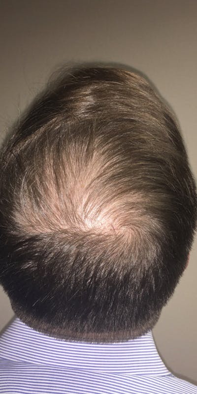 NeoGraft For Men Before & After Gallery - Patient 433578 - Image 1
