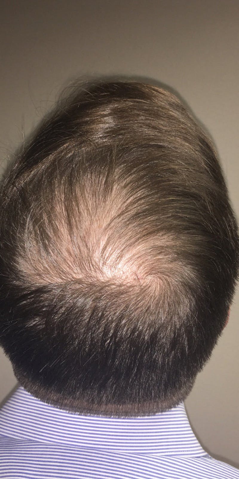 NeoGraft For Men Before & After Gallery - Patient 433578 - Image 1