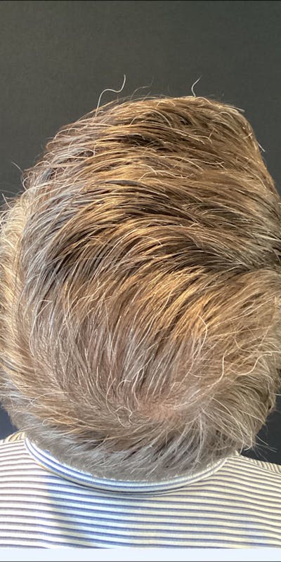 NeoGraft For Men Before & After Gallery - Patient 433578 - Image 2