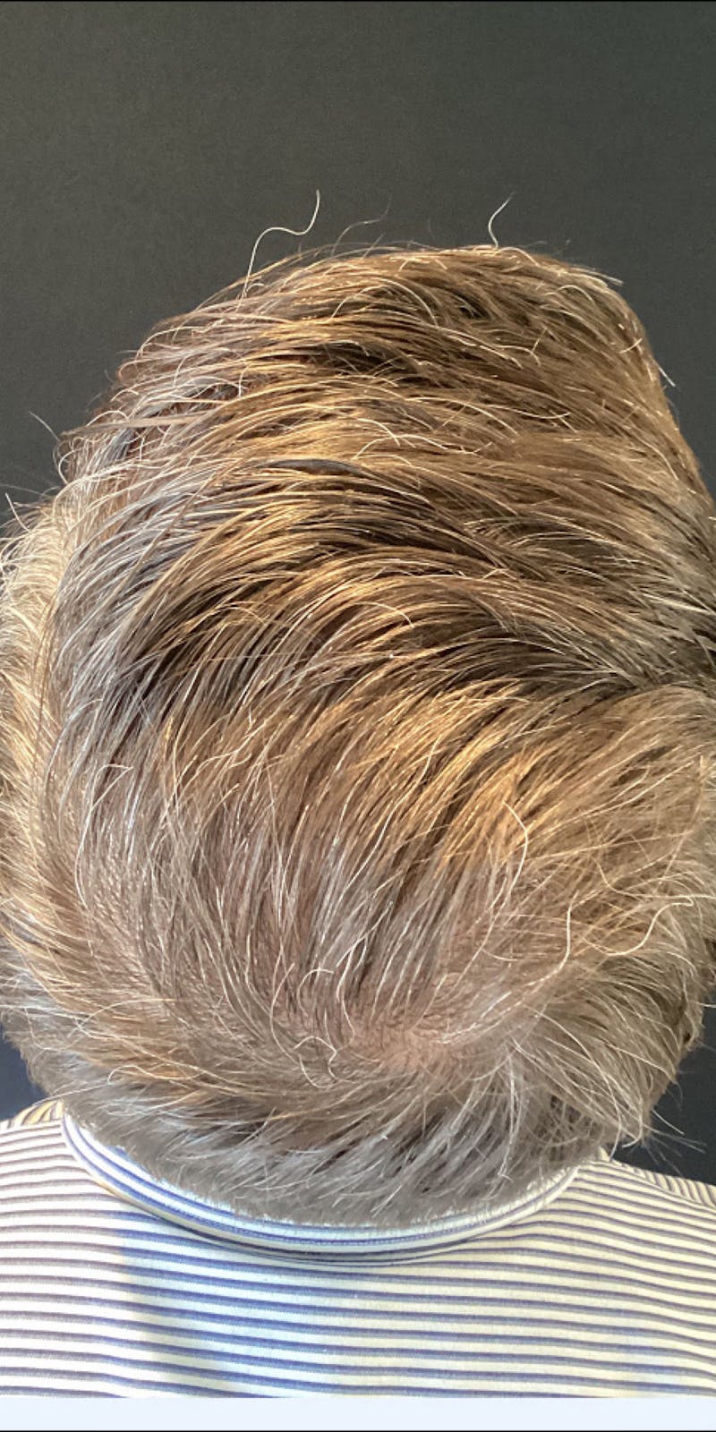 NeoGraft For Men Before & After Gallery - Patient 433578 - Image 2