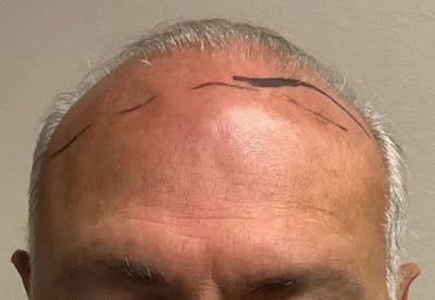 NeoGraft For Men Before & After Gallery - Patient 358486 - Image 1