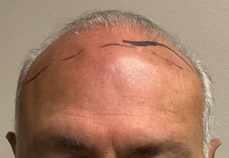 NeoGraft For Men Before & After Gallery - Patient 358486 - Image 1
