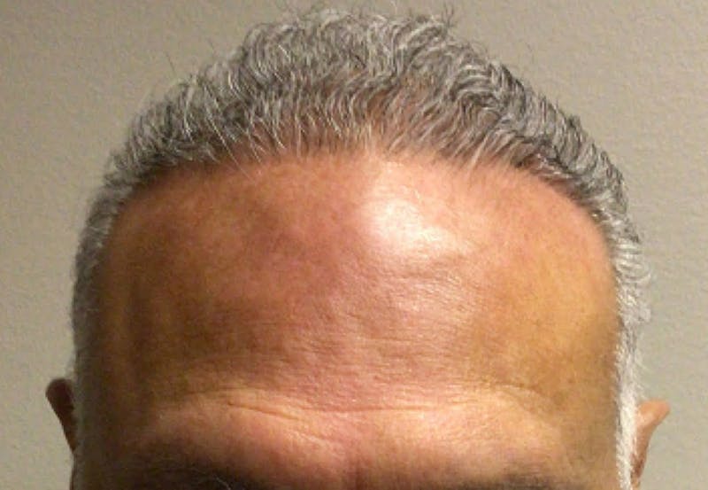 NeoGraft For Men Before & After Gallery - Patient 358486 - Image 2