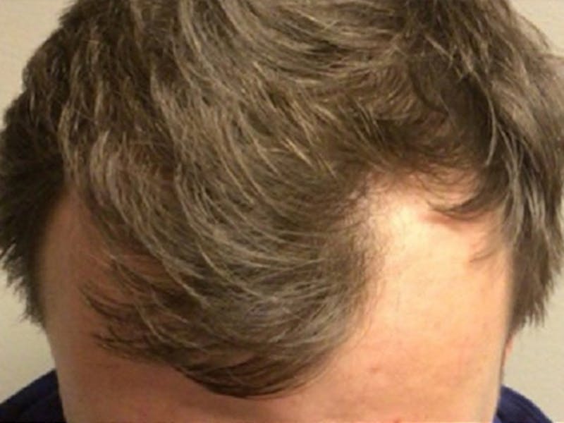 NeoGraft For Men Before & After Gallery - Patient 169622 - Image 1