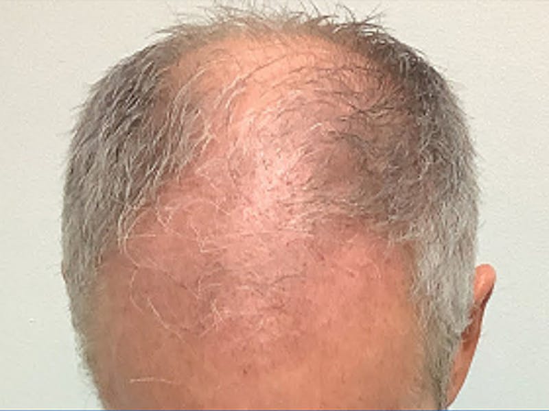 NeoGraft For Men Before & After Gallery - Patient 217030 - Image 1