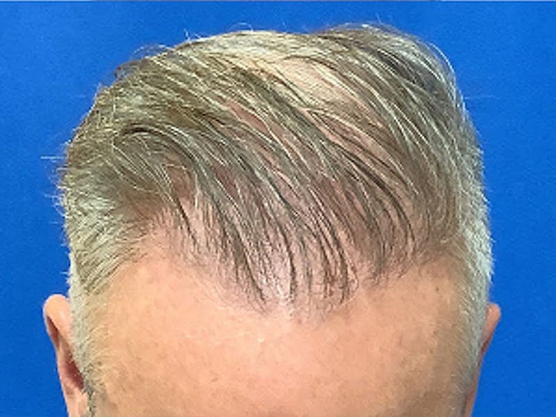 NeoGraft For Men Before & After Gallery - Patient 217030 - Image 2