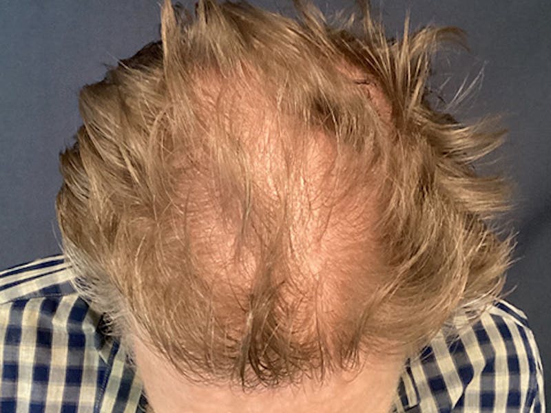 NeoGraft For Men Before & After Gallery - Patient 165185 - Image 1