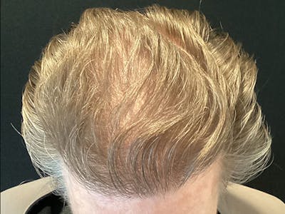 NeoGraft For Men Before & After Gallery - Patient 165185 - Image 2