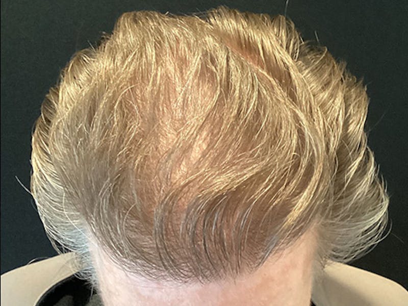 NeoGraft For Men Before & After Gallery - Patient 165185 - Image 2
