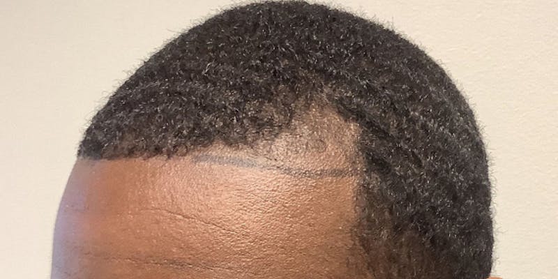 NeoGraft For Men Before & After Gallery - Patient 338667 - Image 1