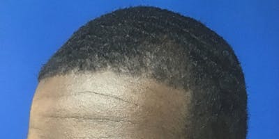 NeoGraft For Men Before & After Gallery - Patient 338667 - Image 2