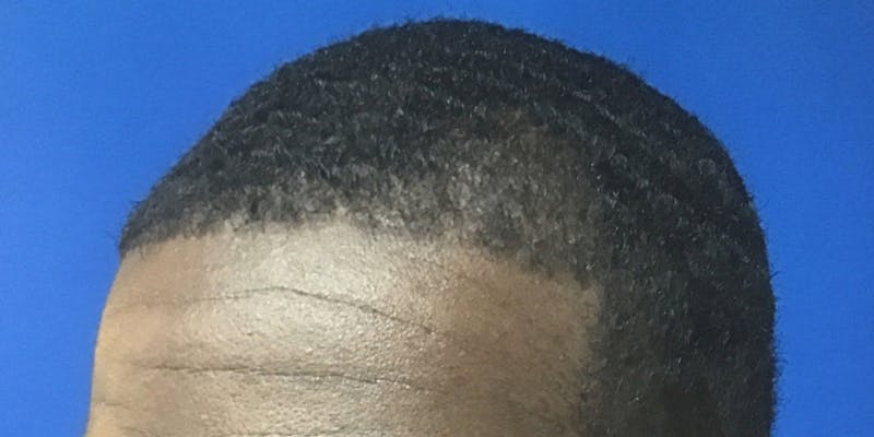 NeoGraft For Men Before & After Gallery - Patient 338667 - Image 2
