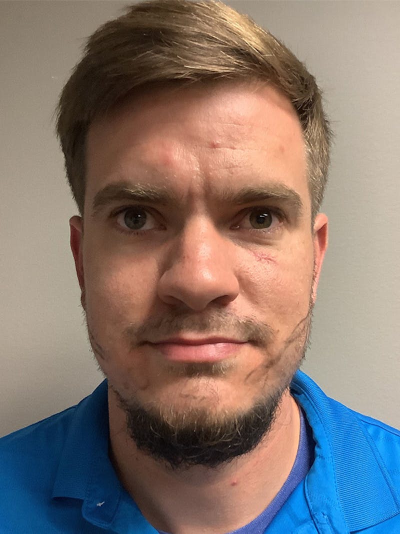 NeoGraft For Men Before & After Gallery - Patient 319538 - Image 1
