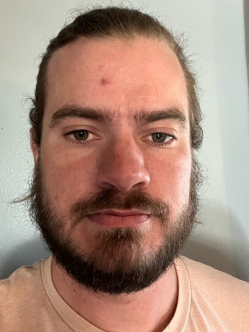 NeoGraft For Men Before & After Gallery - Patient 319538 - Image 2