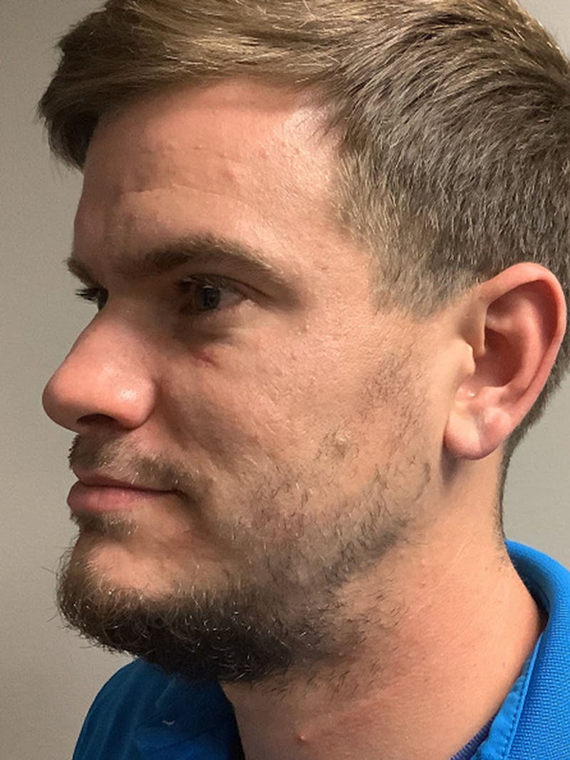 NeoGraft For Men Before & After Gallery - Patient 319538 - Image 3
