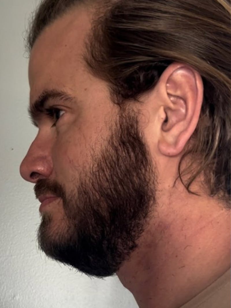 NeoGraft For Men Before & After Gallery - Patient 319538 - Image 4