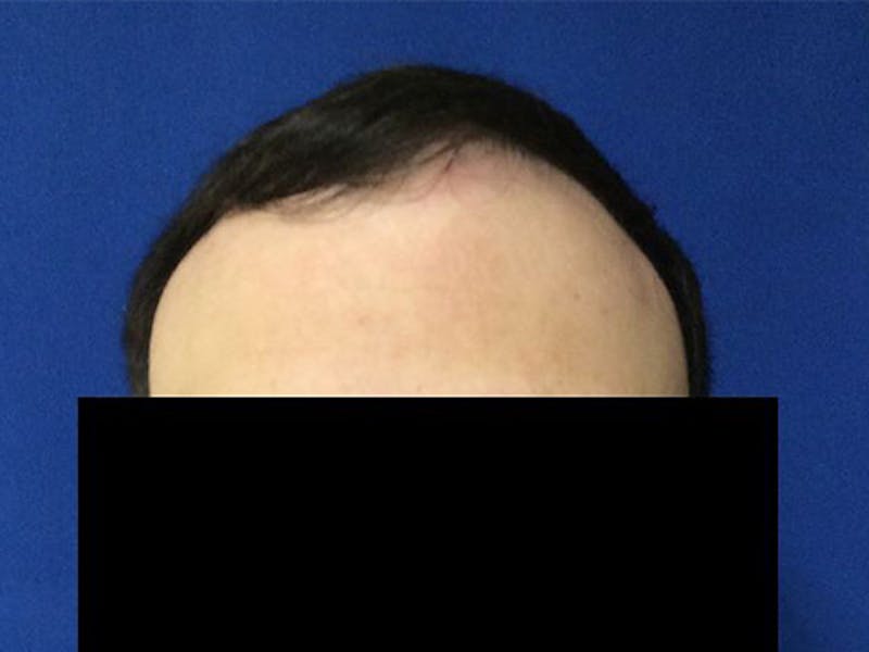 NeoGraft For Men Before & After Gallery - Patient 159085 - Image 1