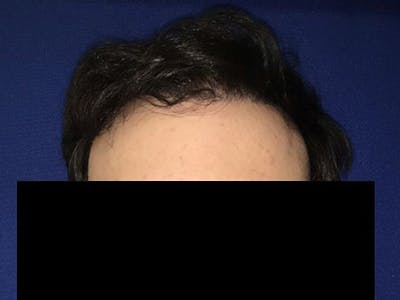 NeoGraft For Men Before & After Gallery - Patient 159085 - Image 2