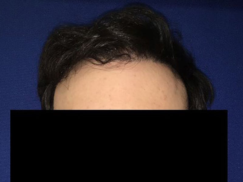 NeoGraft For Men Before & After Gallery - Patient 159085 - Image 2