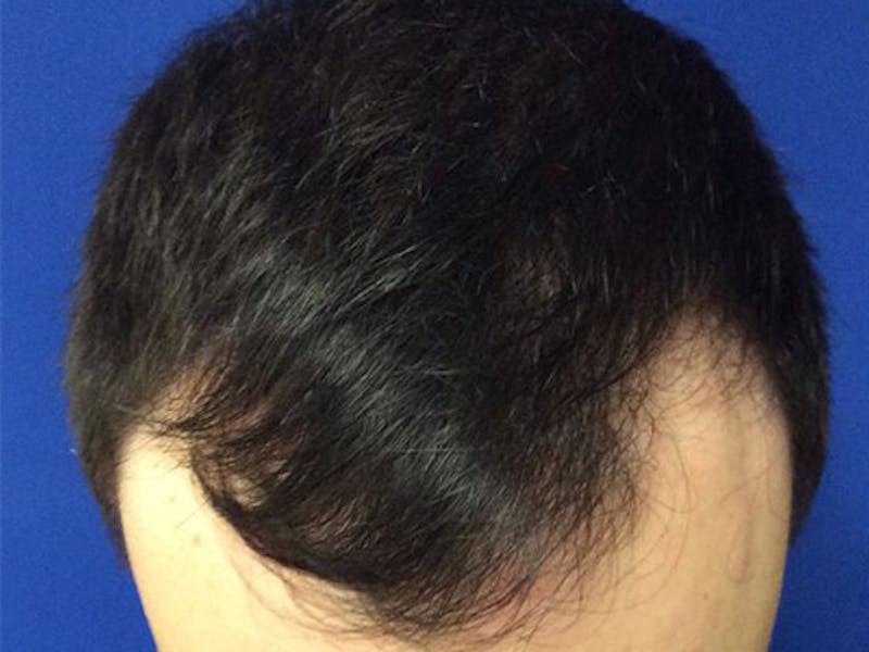 NeoGraft For Men Before & After Gallery - Patient 159085 - Image 3