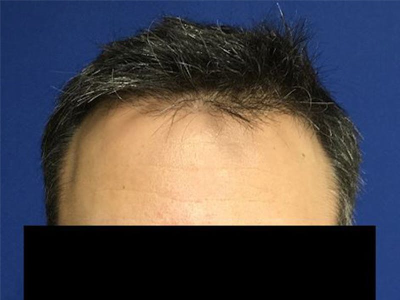 NeoGraft For Men Before & After Gallery - Patient 152496 - Image 1