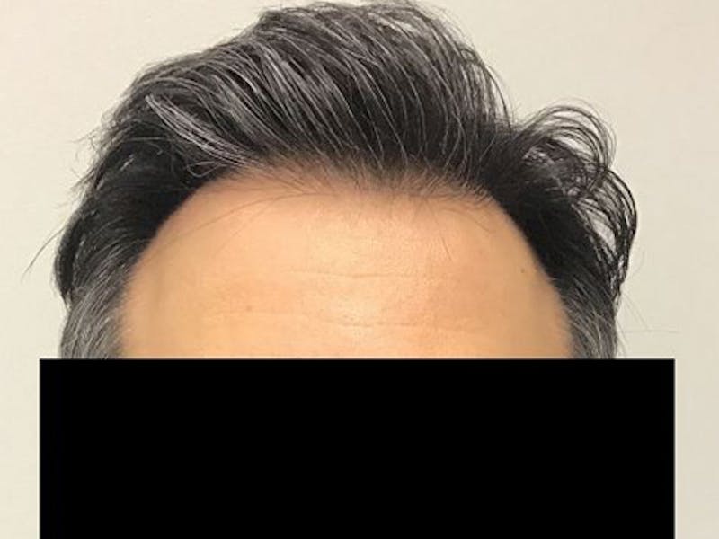 NeoGraft For Men Before & After Gallery - Patient 152496 - Image 2