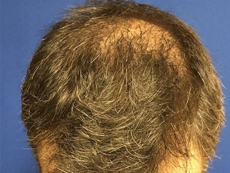 NeoGraft For Men Before & After Gallery - Patient 152496 - Image 3