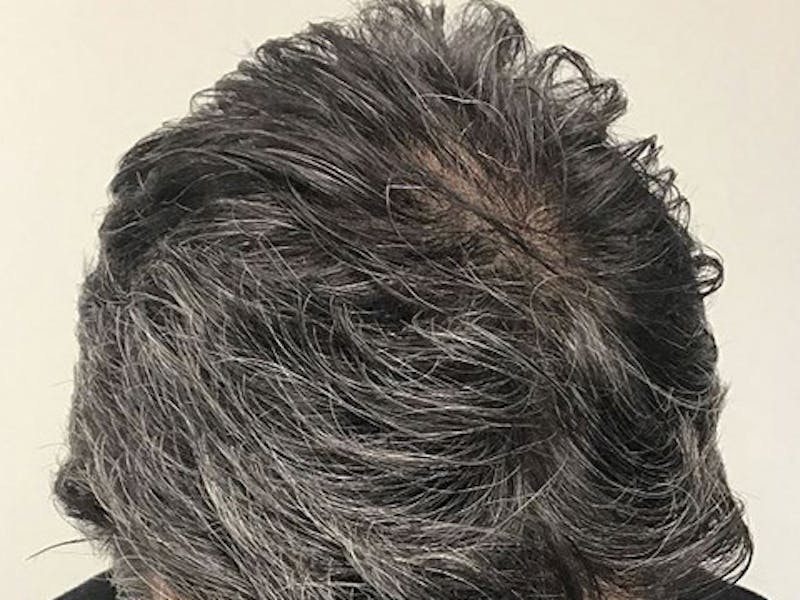 NeoGraft For Men Before & After Gallery - Patient 152496 - Image 4