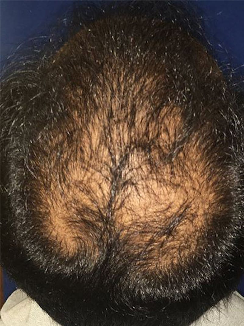 NeoGraft For Men Before & After Gallery - Patient 171593 - Image 1