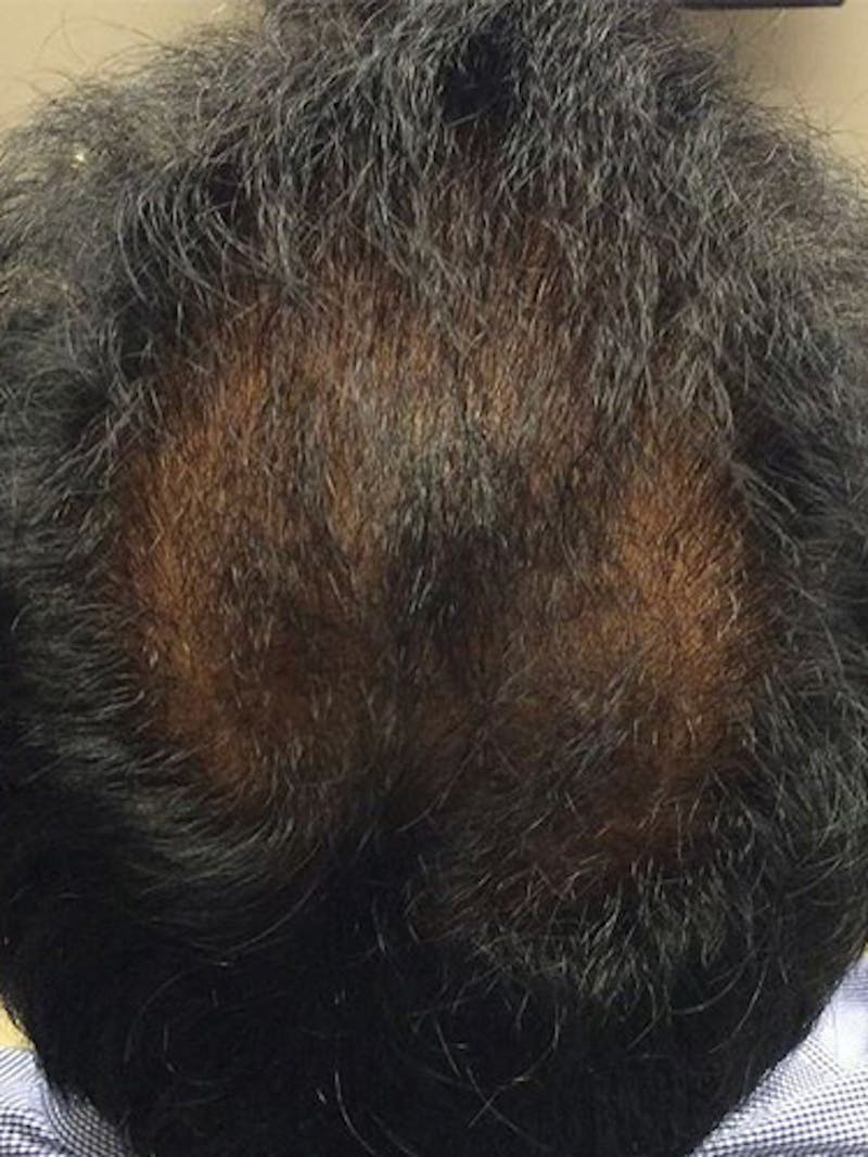 NeoGraft For Men Before & After Gallery - Patient 171593 - Image 2
