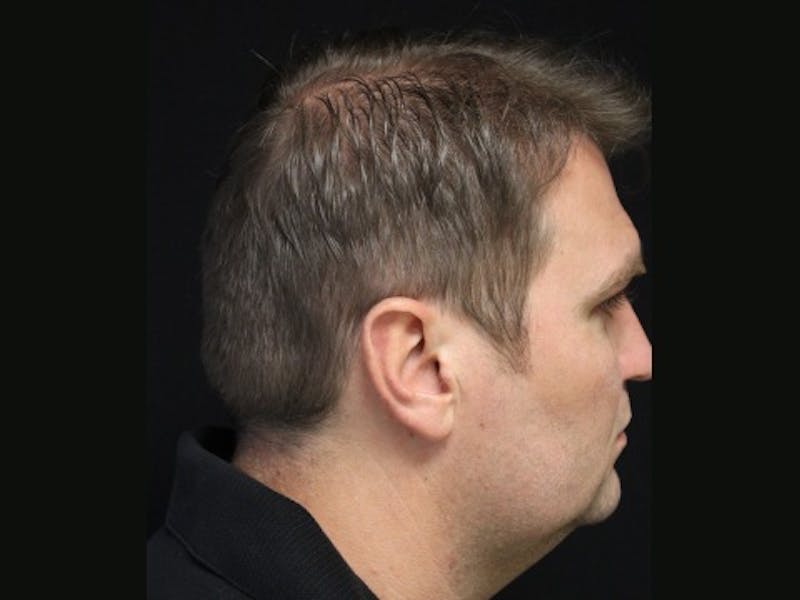 NeoGraft For Men Before & After Gallery - Patient 141011 - Image 4