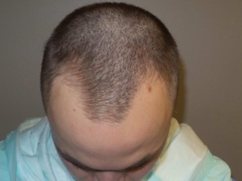 NeoGraft For Men Before & After Gallery - Patient 304210 - Image 1