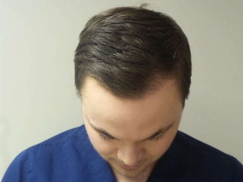 NeoGraft For Men Before & After Gallery - Patient 304210 - Image 2