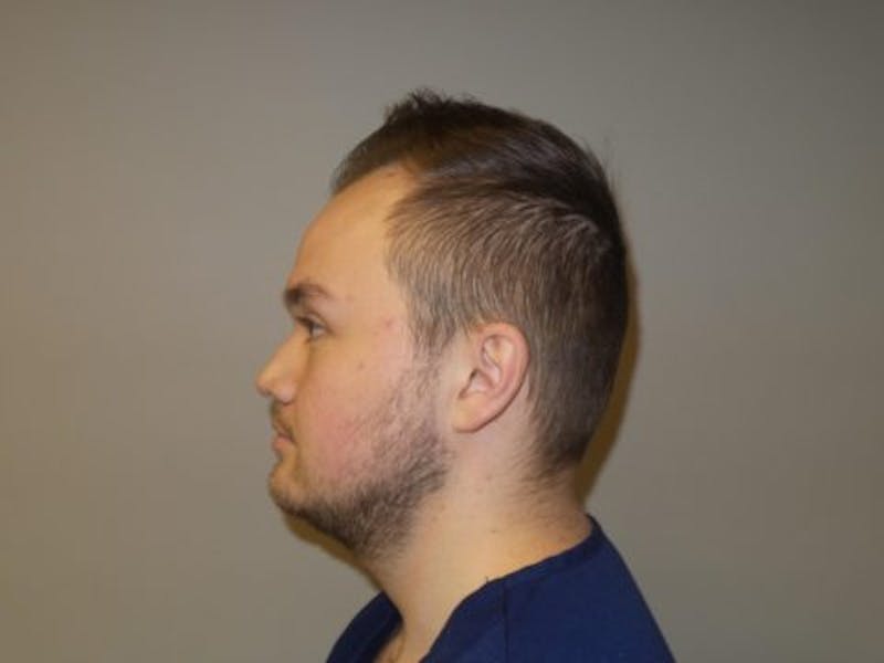 NeoGraft For Men Before & After Gallery - Patient 304210 - Image 3