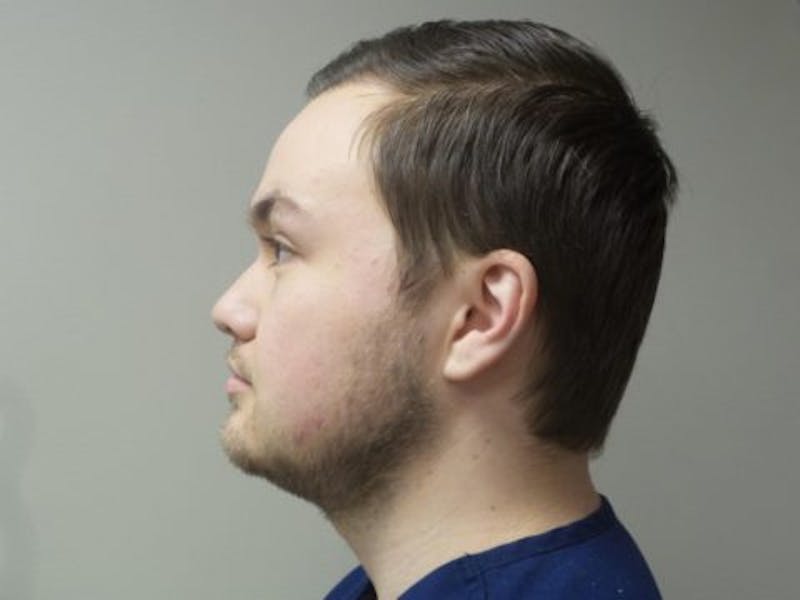 NeoGraft For Men Before & After Gallery - Patient 304210 - Image 4