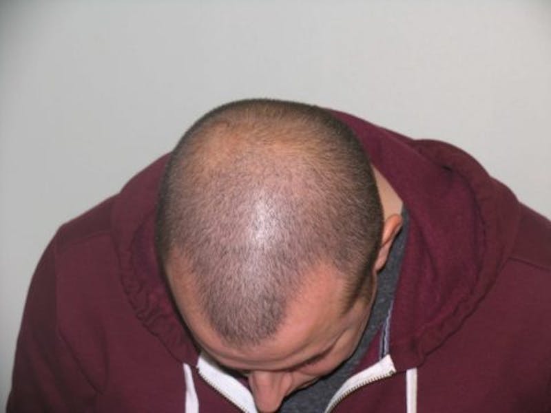 NeoGraft For Men Before & After Gallery - Patient 188899 - Image 1