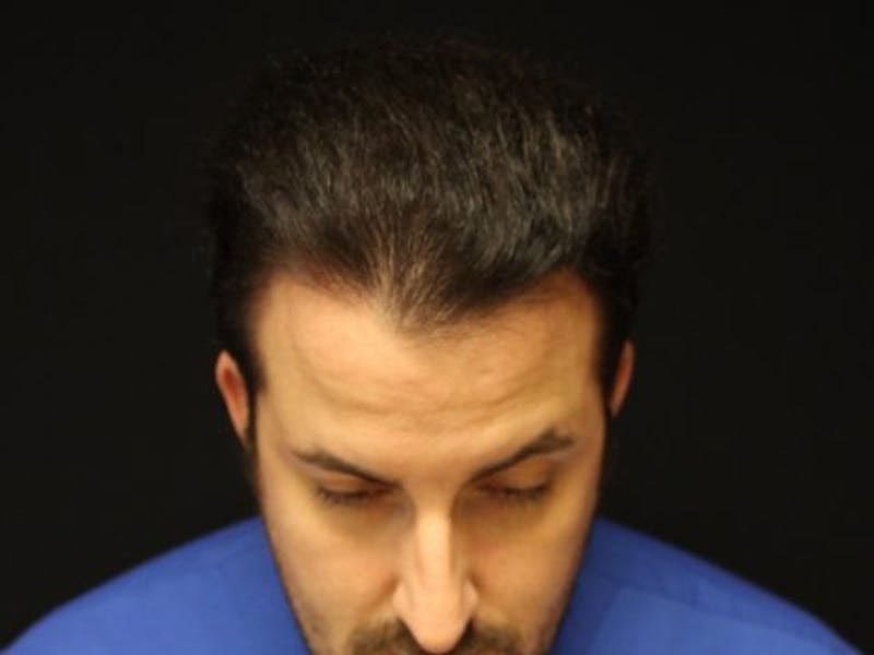 NeoGraft For Men Before & After Gallery - Patient 188899 - Image 2