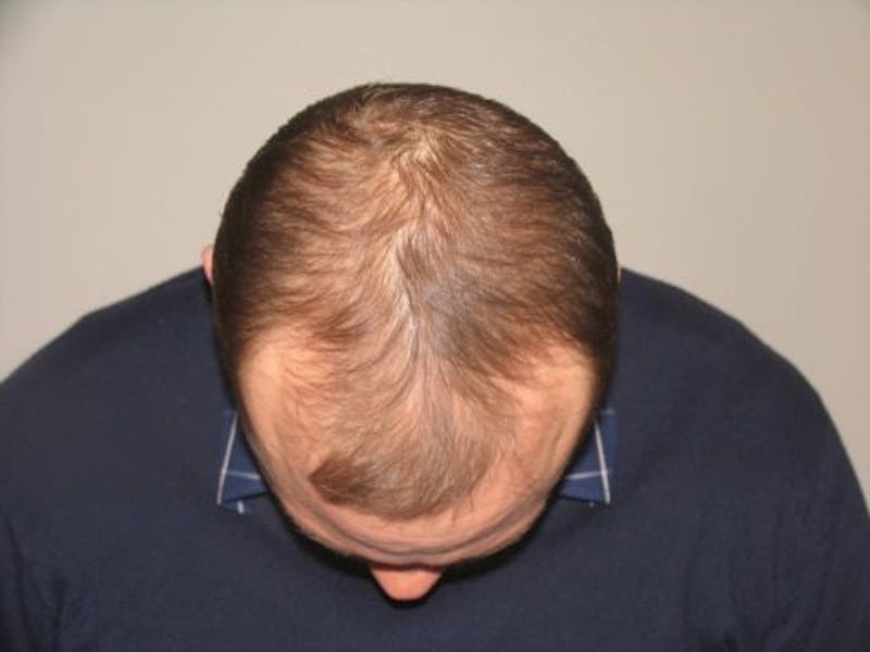 NeoGraft For Men Before & After Gallery - Patient 144888 - Image 1