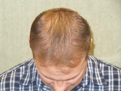 NeoGraft For Men Before & After Gallery - Patient 144888 - Image 2