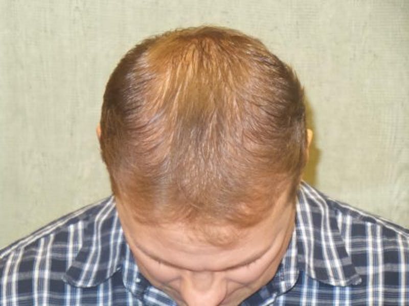 NeoGraft For Men Before & After Gallery - Patient 144888 - Image 2